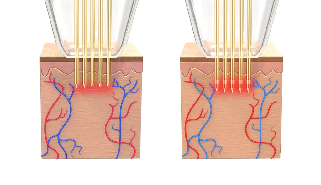 Microagujas de la plataforma Potenza aplicando radiofrecuencia en la dermis